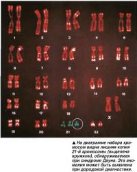 Лишняя копия 21-й хромосомы
