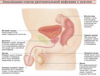 Локализация очагов урогенитальной инфекции у мужчин