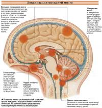 Локализация опухолей мозга