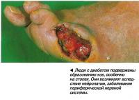 Люди с диабетом подвержены образованию язв