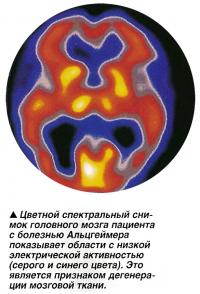 Люди, страдающие болезнью Альцгеймера, нуждаются в специализированном уходе