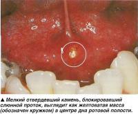Мелкий отвердевший камень, блокировавший слюнной проток
