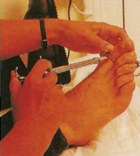 Местный анестетик вводится в большой палец ноги перед удалением вросшего ногтя