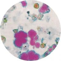 Микроснимок показывает окрашенные по Граму колонии стрептококка