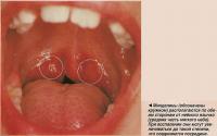 Миндалины (обозначены кружком) располагаются по обеим сторонам от небного язычка