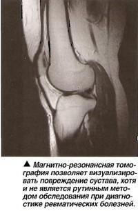 МРТ позволяет визуализировать повреждение сустава