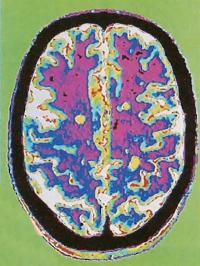 МРТ-снимок пораженного головного мозга, бляшки PC выглядят как наиболее бледные области