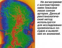 На ангиограмме с контрастированием показана левая сонная артерия