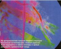 На артериограмме показан момент операции баллонной ангиопластики