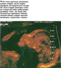 На цветном ультразвуковом снимке четко виден профиль 20-недельного плода