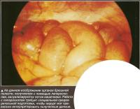 На данном изображении органов брюшной полости визуализируются петли кишечника
