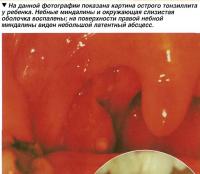 На данной фотографии показана картина острого тонзиллита у ребенка