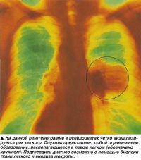 На данной рентгенограмме в псевдоцветах четко визуализируется рак легкого