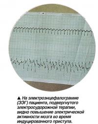 На электроэнцефалограмме (ЭЭГ) пациента, видно повышение электрической активности мозга
