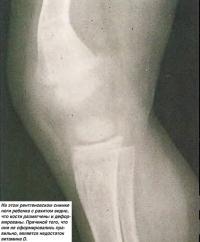 На этом снимке ноги с рахитом видно, что кости размягчены и деформированы