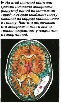 На этой цветной рентгенограмме показана аневризма (вздутие) одной из сонных артерий