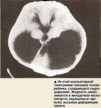 На этой компьютерной томограмме показана голова ребенка, страдающего гидроцефалией