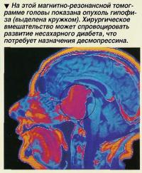 На этой магнитно-резонансной томограмме головы показана опухоль гипофиза