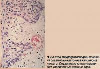 На этой микрофотографии показана сквамозно-клеточная карцинома легкого