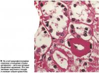 На этой микрофотографии показано утолщение стенки артериолы