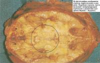 На фотографии изображена опухоль надпочечника в разрезе