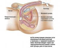 На иллюстрации показан установленный мочевой катетер у мужчины