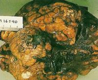 На извлеченном мозге справа виден ушиб с размозжением ткани