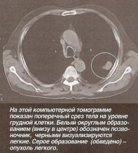 На компьютерной томограмме показан поперечный срез тела на уровне грудной клетки