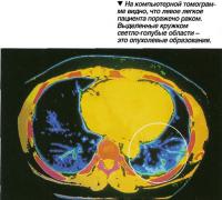 На компьютерной томограмме видно, что левое легкое пациента поражено раком