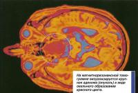 На магнитнорезонансной томограмме визуализируется крупная аденома