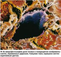 На микрофотографии доли печени в псевдоцветах изображены клетки, пораженные циррозом