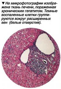 На микрофотографии изображена ткань печени, пораженная хроническим гепатитом