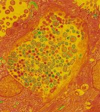 На микроснимке — клетки маточной трубы с бактериями Chlamydia trachomatis (зелёно-коричневые)