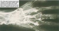 На рентгеноконтрастном снимке отчетливо видна артериовенозная фистула
