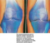 На рентгеновском снимке показаны коленные суставы, пораженные артритом