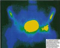 На сцинтиграмме первичный рак предстательной железы