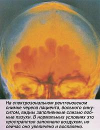 На снимке черепа пациента, больного синуситом, видны заполненные слизью лобные пазухи