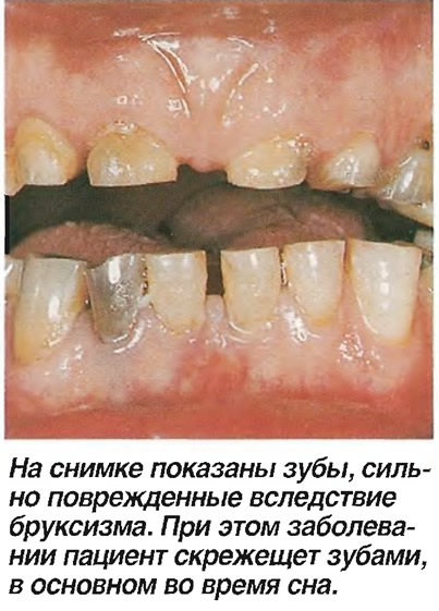 На снимке показаны зубы, сильно поврежденные вследствие бруксизма