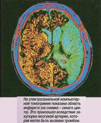На спектрозональной компьютерной томограмме показана область инфаркта