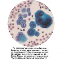 На световой микрофотографии изображены клетки мезотелиомы