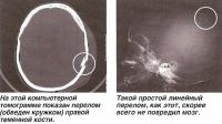 На томограмме показан перелом правой теменной кости