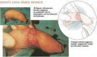 Надрез внешнего слоя кожи пениса