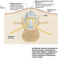 Нервная бляшка погружается внутрь мешка в спинномозговой канал