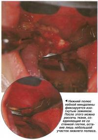 Нижний полюс небной миндалины фиксируется изогнутым зажимом
