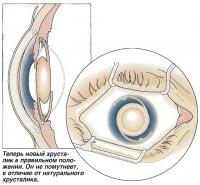 Новый хрусталик в правильном положении