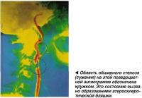 Область обширного стеноза (сужения)
