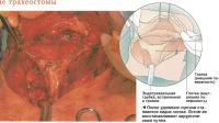 Образование трахеостомы