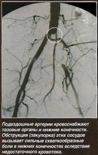 Обструкция подвздошной артерии