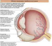 Обзор операции трабекулэктомии