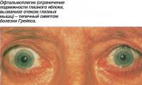 Офтальмоплегия (ограничение подвижности глазного яблока)